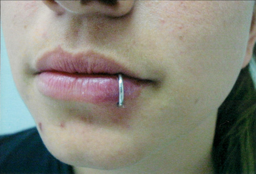 Piercing na boca: conheça os riscos para a sua saúde bucal